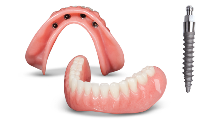 Snap-In Dentures in Schaumburg, IL | Stabilize Your Dentures