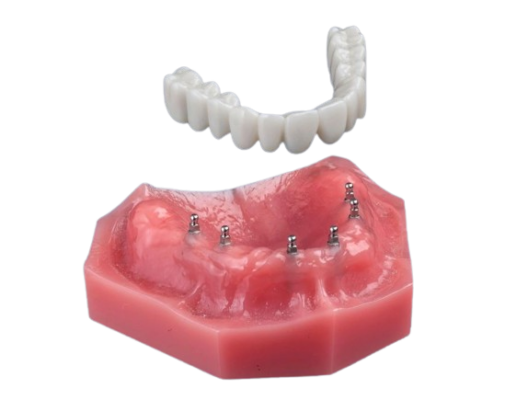 Mini Implants in Schaumburg, IL | Book a Free Implant Consultation