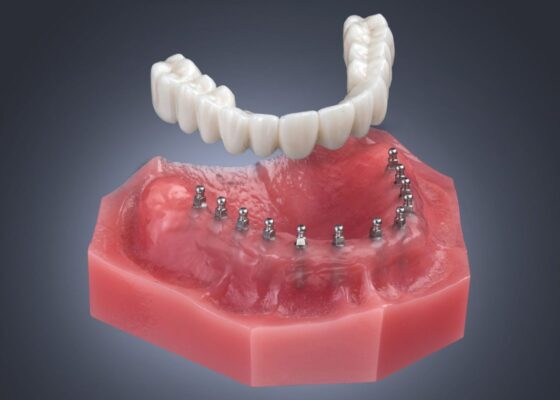 Mini Implant Dentures in Schaumburg, IL | Free Consultations