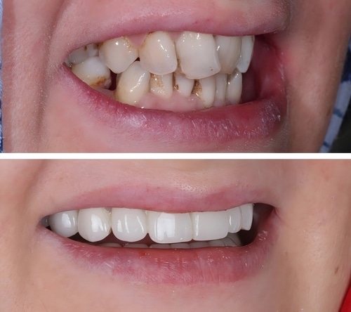 Veneers vs. Bonding in Schaumburg, IL | Perfect Your Smile