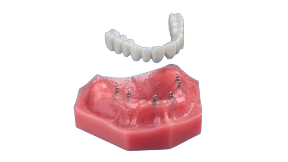 Denture Replacement in Schaumburg, IL | Free Implant Consult!