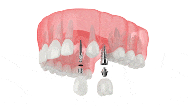 Schaumburg Dental Implants | Free Implant Consultations in IL