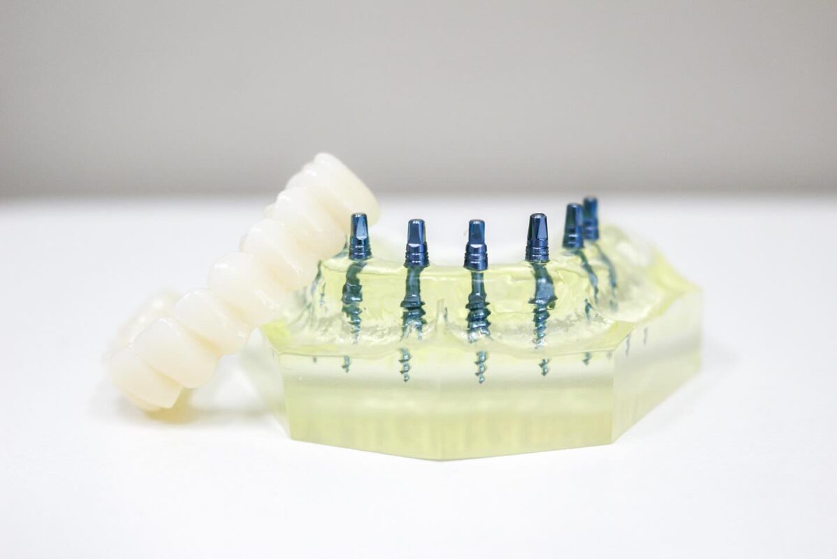Implants for Denture Security in Schaumburg, IL | Free Consultation
